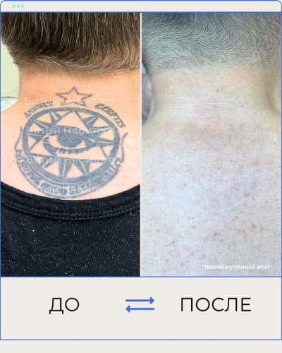 Удаление татуировки
